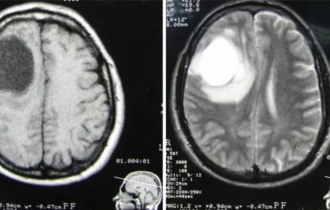 МРТ при астроцитоме головного мозга