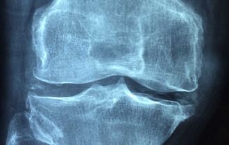 МРТ коленного сустава при гонартрозе