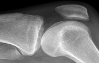 Что показывает МРТ коленных суставов, как делают процедуру: расшифровка и противопоказания