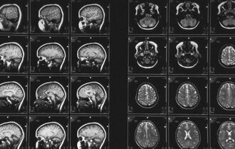 Как и для чего проводится МРТ при болезни Альцгеймера