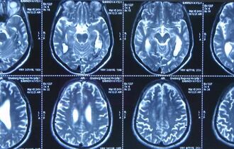 Особенности проведения МРТ головного мозга ребенку