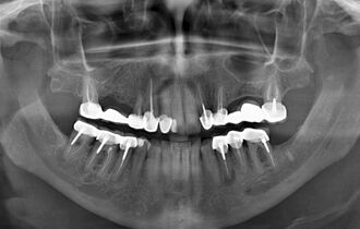 Можно ли делать МРТ со штифтом в зубах