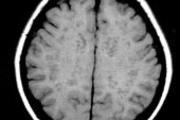 снимок кт головного мозга
