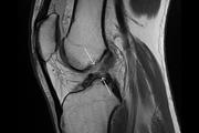 Снимки МРТ коленного сустава