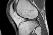 магнитно-резонансная томография коленного сустава