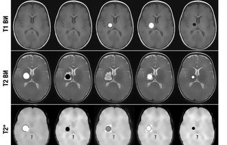 Гематома на МРТ головного мозга