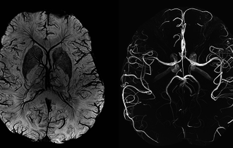 МРТ головного мозга при черепно-мозговых травмах