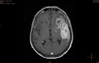 Отек головного мозга на МРТ