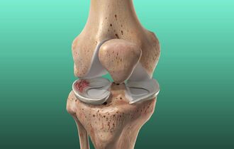 Виды, симптоматика, причины и лечение повреждений мениска коленного сустава