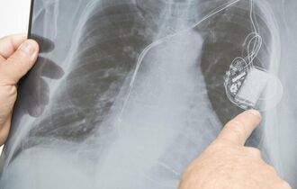 Можно ли делать МРТ с кардиостимулятором