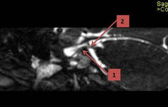 Что показывает МРТ тройничного нерва