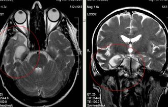 МРТ при нейродегенерации головного мозга