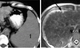 МРТ в диагностике цирроза печени